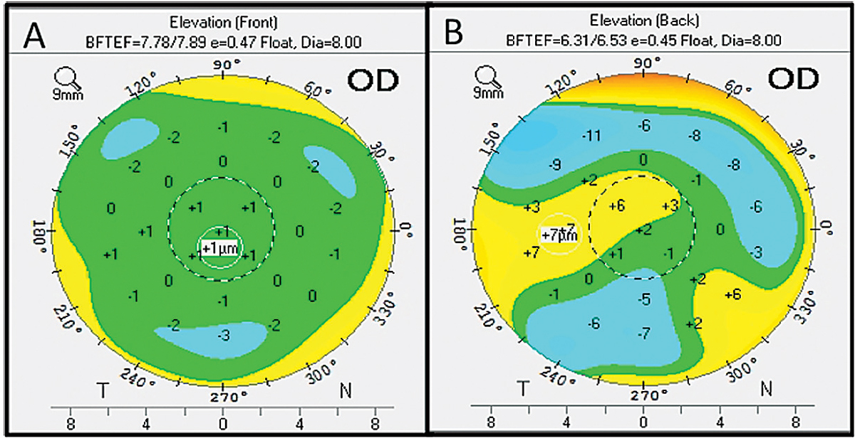 Angle Kappa May Affect Diagnostic Accuracy In Refractive Surgery Patients